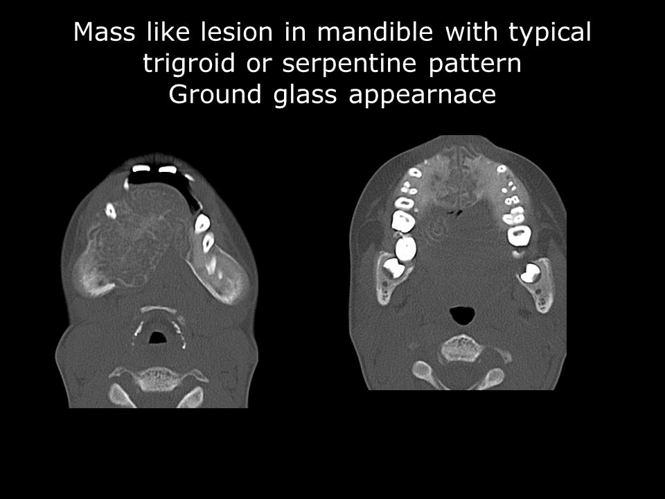 Mass like lesion in mandible with typical trigroid or serpentine pattern Ground glass appearnace