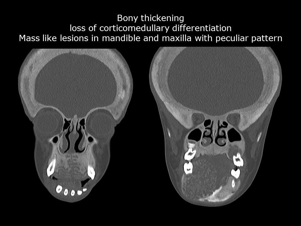 Bony thickening loss of corticomedullary differentiation Mass like lesions in mandible and maxilla with peculiar pattern
