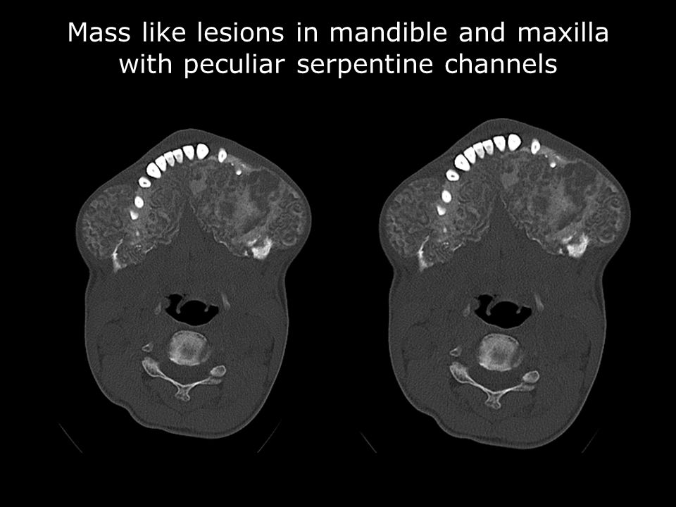 Mass like lesions in mandible and maxilla with peculiar serpentine channels