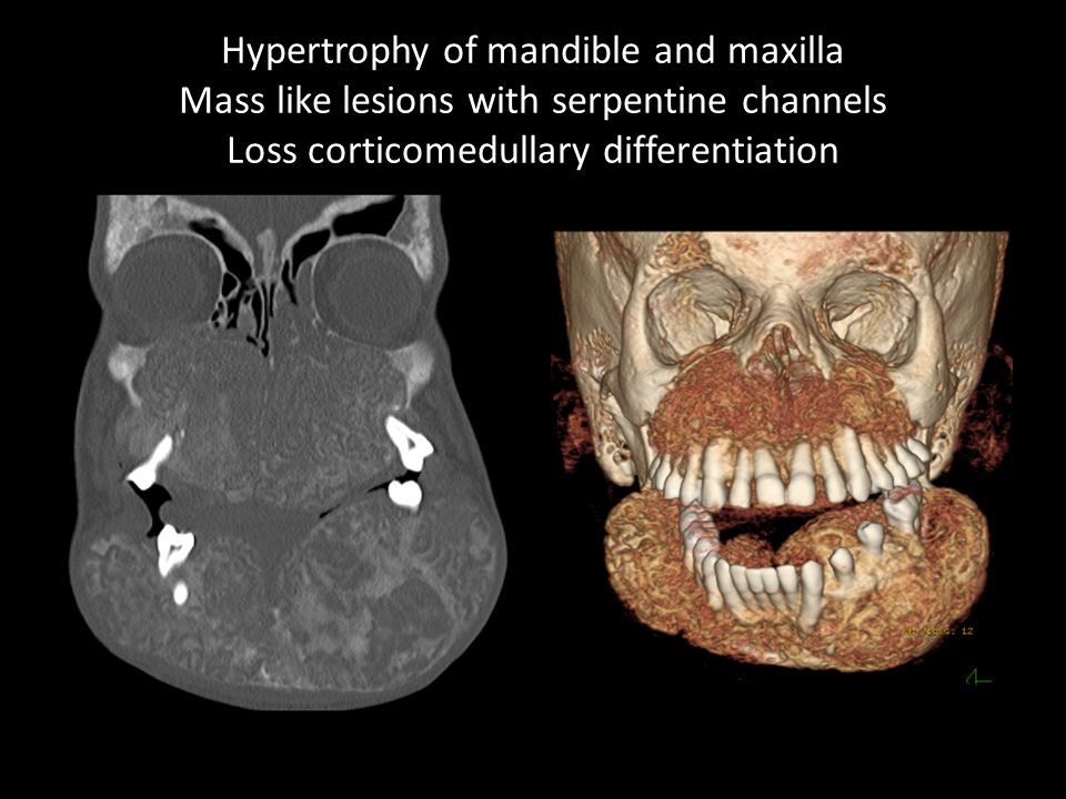 Hypertrophy of mandible and maxilla Mass like lesions with serpentine channels Loss corticomedullary differentiation