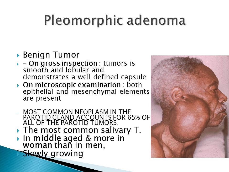 pleomorphic adenoma