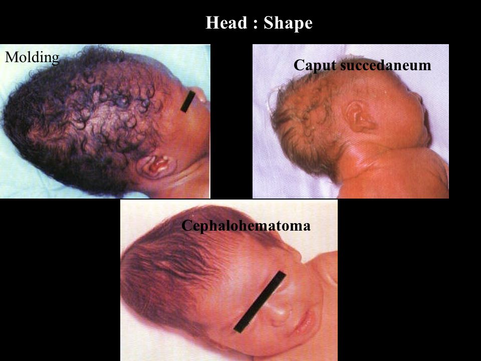 caput succedaneum