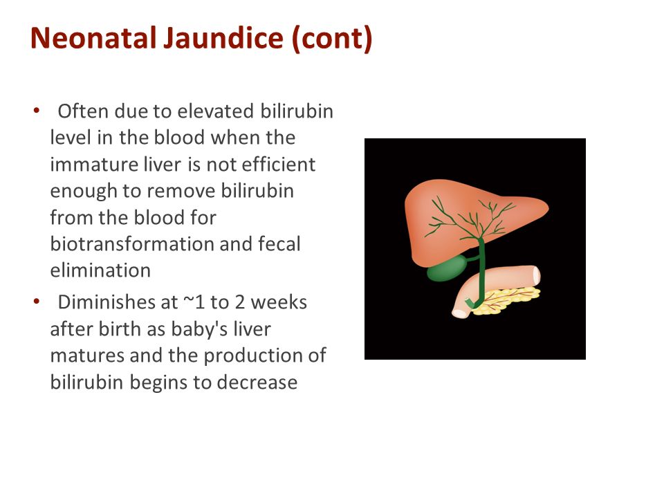 Neonatal Jaundice (cont) Often due to elevated bilirubin level in the blood when the immature liver is not efficient enough to remove bilirubin from the blood for biotransformation and fecal elimination Diminishes at ~1 to 2 weeks after birth as baby s liver matures and the production of bilirubin begins to decrease