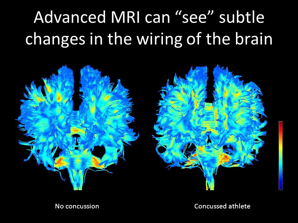 Advanced MRI can see subtle changes in the wiring of the brain No concussionConcussed athlete