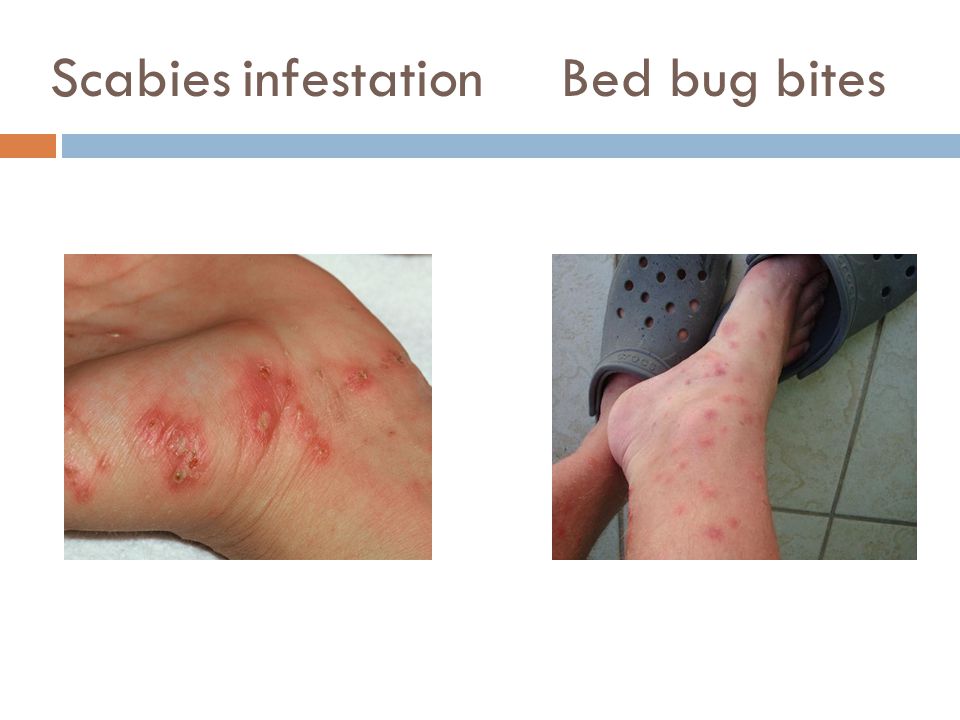 Scabies Mild Bed Bug Bites