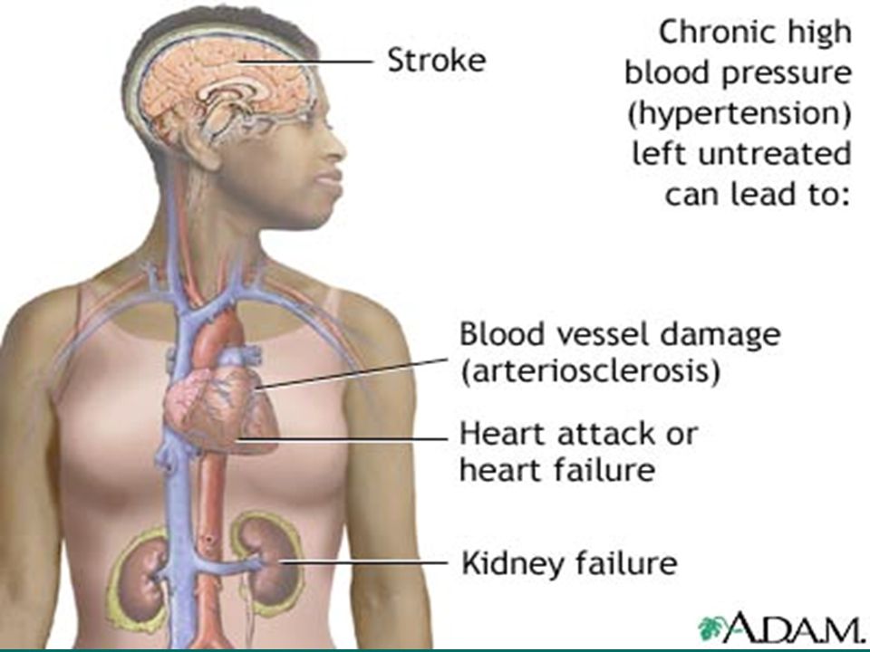 Can high blood pressure cause nose bleeding / What is a pe in ... Can high blood pressure cause nose bleeding / What is a pe in ...