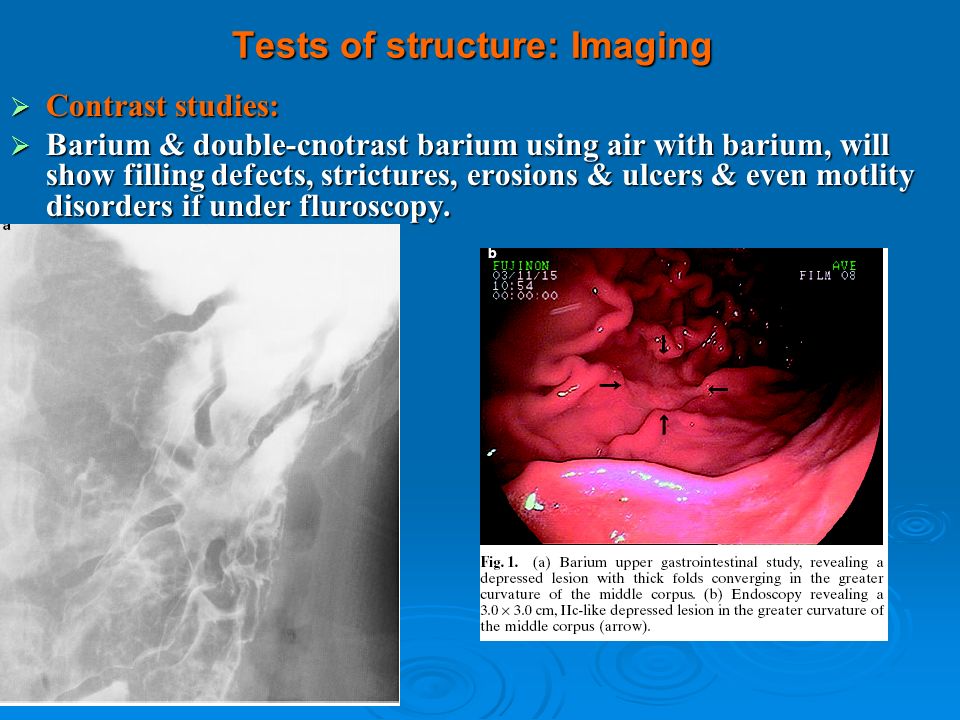 Contrast studies: Contrast studies: Barium & double-cnotrast barium using air with barium, will show filling defects, strictures, erosions & ulcers & even motlity disorders if under fluroscopy.