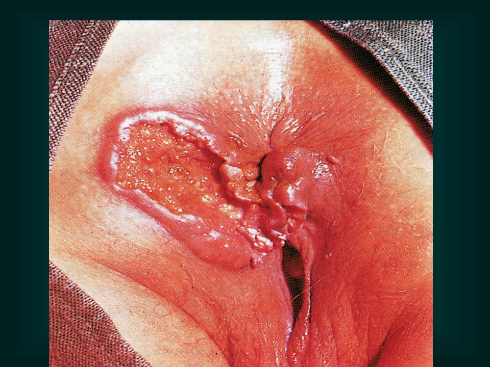 Think, lesions to the anus recommend Lesions to the anus And