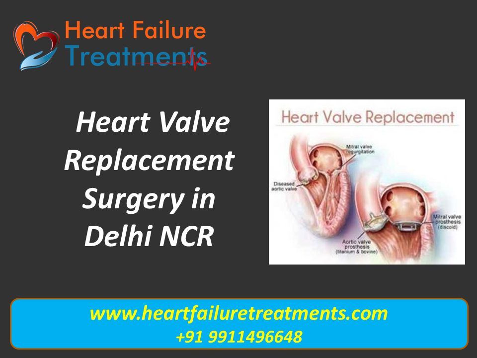 Heart Valve Replacement Surgery in Delhi NCR