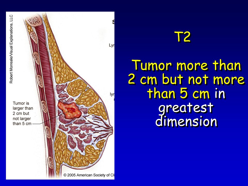 T2 Tumor more than 2 cm but not more than 5 cm in greatest dimension