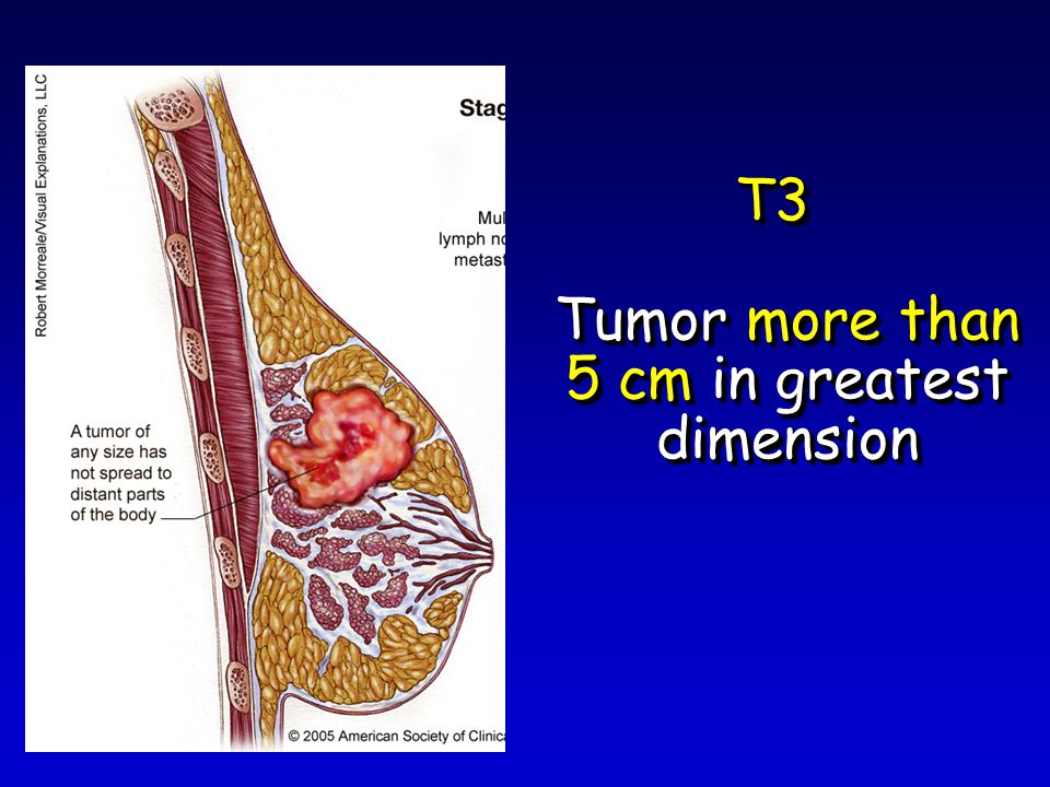 T3 Tumor more than 5 cm in greatest dimension