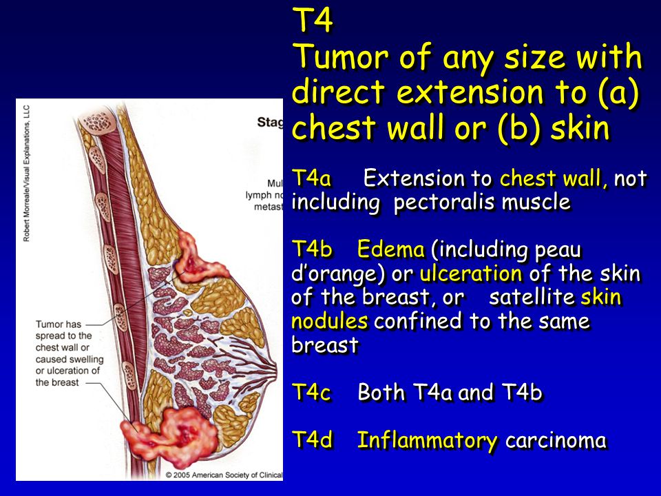 T4 Tumor of any size with direct extension to (a) chest wall or (b) skin T4a Extension to chest wall, not including pectoralis muscle T4b Edema (including peau d’orange) or ulceration of the skin of the breast, or satellite skin nodules confined to the same breast T4cBoth T4a and T4b T4dInflammatory carcinoma