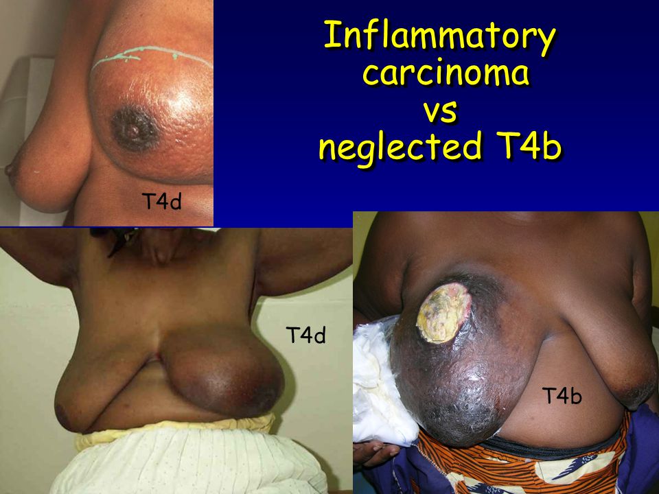 Inflammatory carcinoma vs neglected T4b T4d T4b