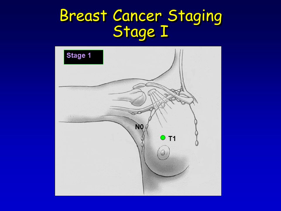 Breast Cancer Staging Stage I Stage 1 T1 N0