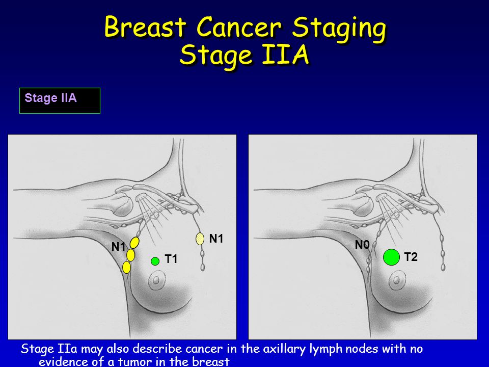Breast Cancer Staging Stage IIA Stage IIA T1 N1 T2 N0 N1 Stage IIa may also describe cancer in the axillary lymph nodes with no evidence of a tumor in the breast