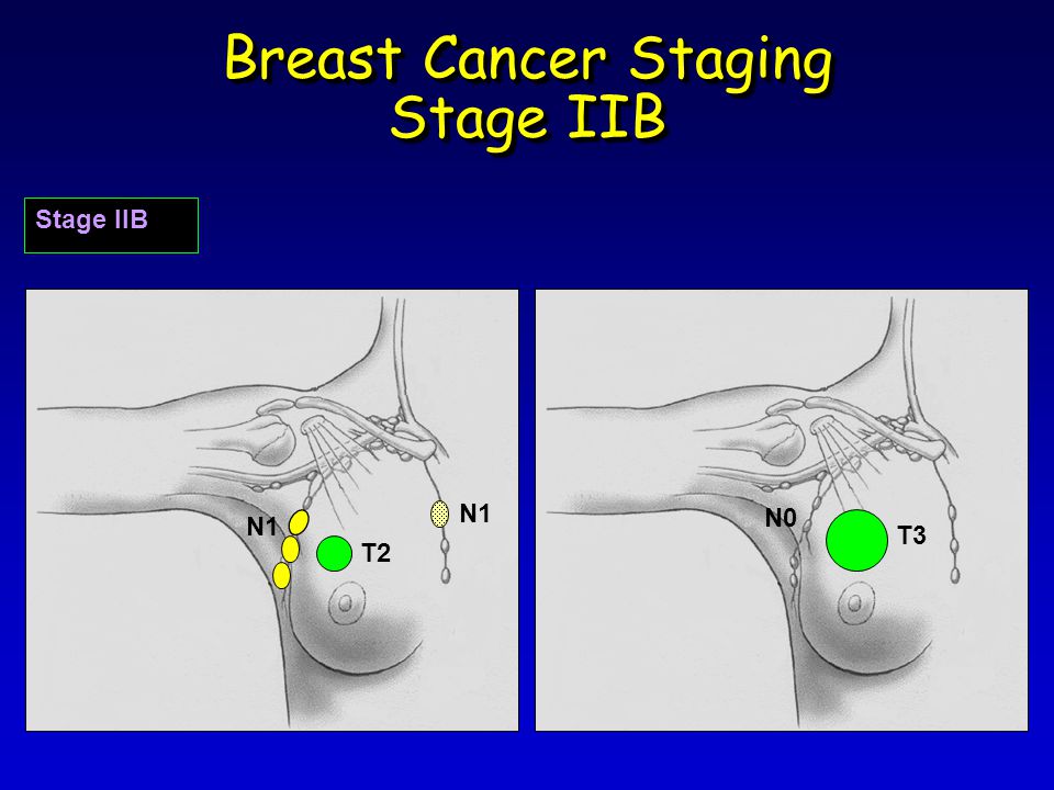Breast Cancer Staging Stage IIB Stage IIB T2 N1 T3 N0 N1
