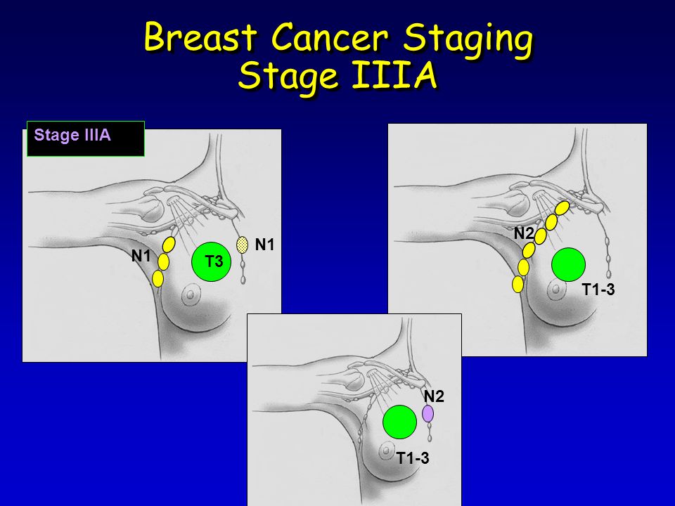 Breast Cancer Staging Stage IIIA N1 T3 N1 Stage IIIA T1-3 N2 T1-3