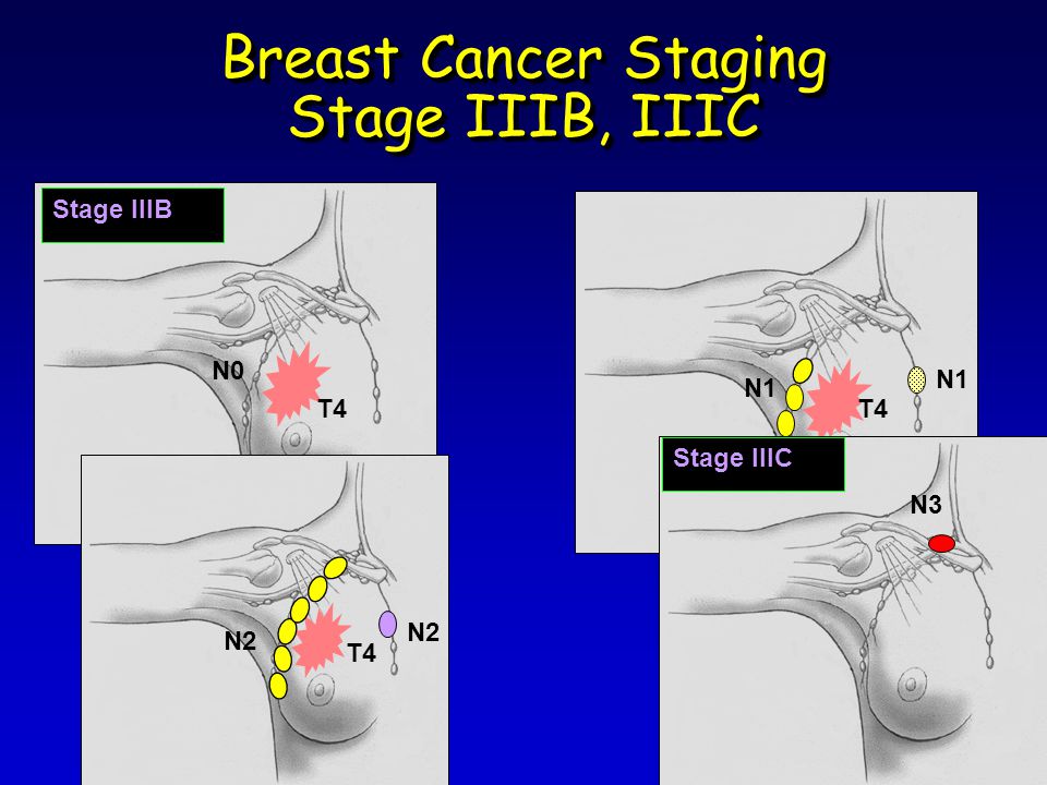 Breast Cancer Staging Stage IIIB, IIIC Stage IIIB T4 N1 T4 N2 N3 N0 Stage IIIC