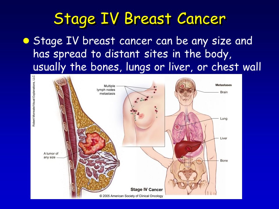 Stage IV Breast Cancer l Stage IV breast cancer can be any size and has spread to distant sites in the body, usually the bones, lungs or liver, or chest wall