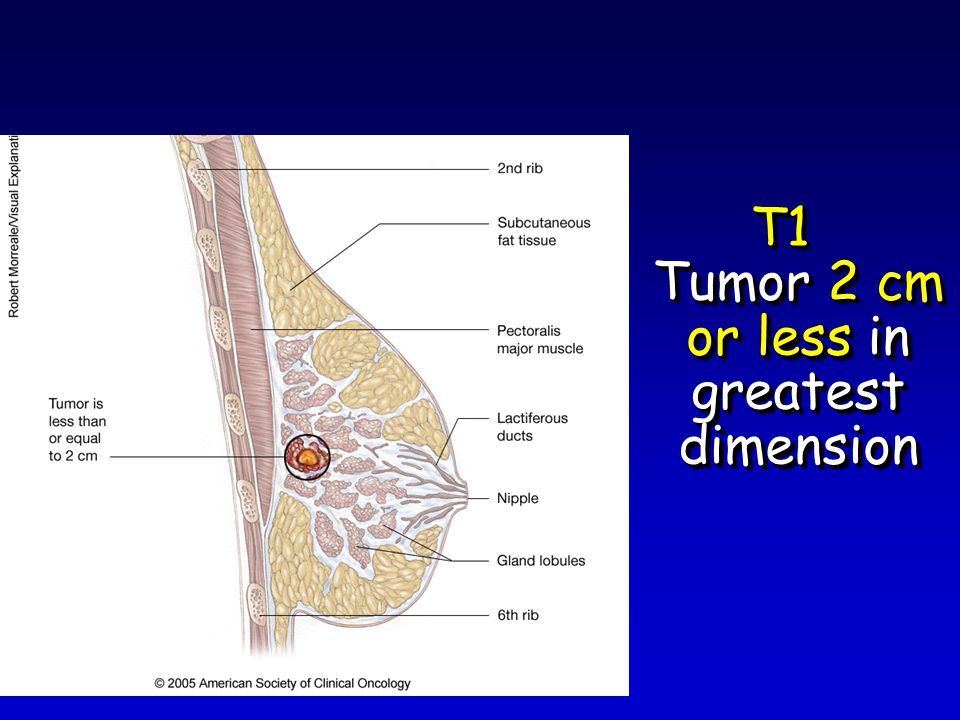 T1 Tumor 2 cm or less in greatest dimension