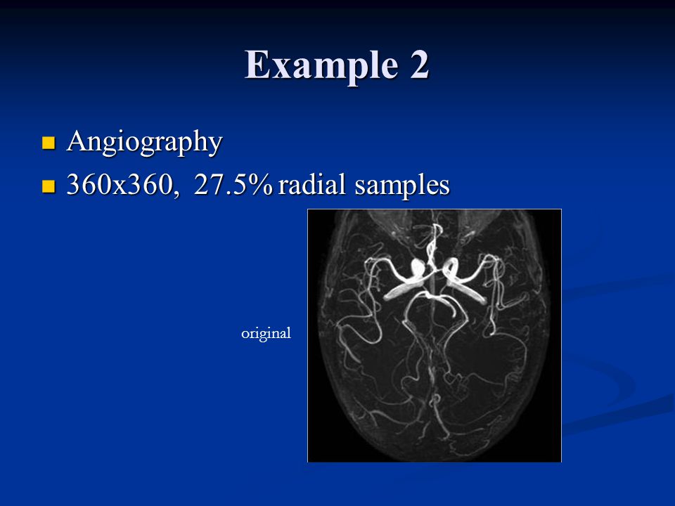 Example 2 Angiography Angiography 360x360, 27.5% radial samples 360x360, 27.5% radial samples original