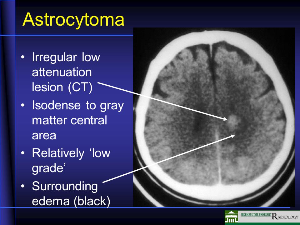 Astrocytoma Irregular low attenuation lesion (CT) Isodense to gray matter central area Relatively ‘low grade’ Surrounding edema (black)