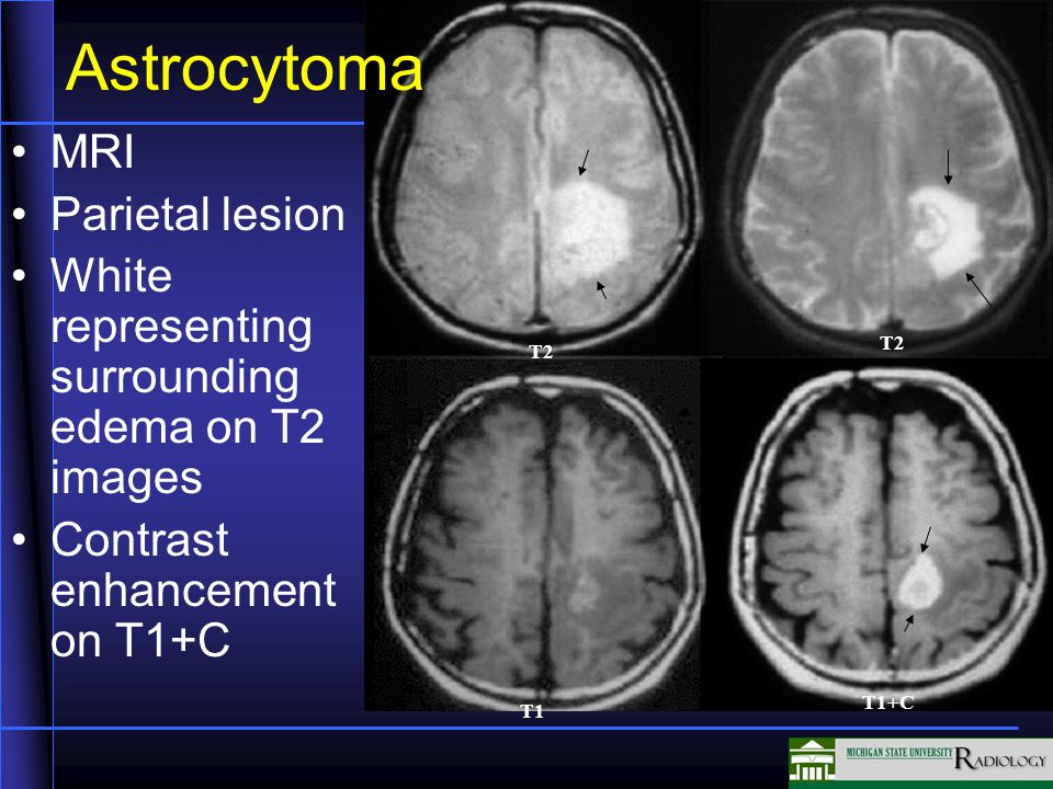 Astrocytoma MRI Parietal lesion White representing surrounding edema on T2 images Contrast enhancement on T1+C T2 T1 T1+C