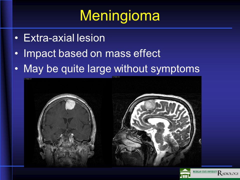Meningioma Extra-axial lesion Impact based on mass effect May be quite large without symptoms