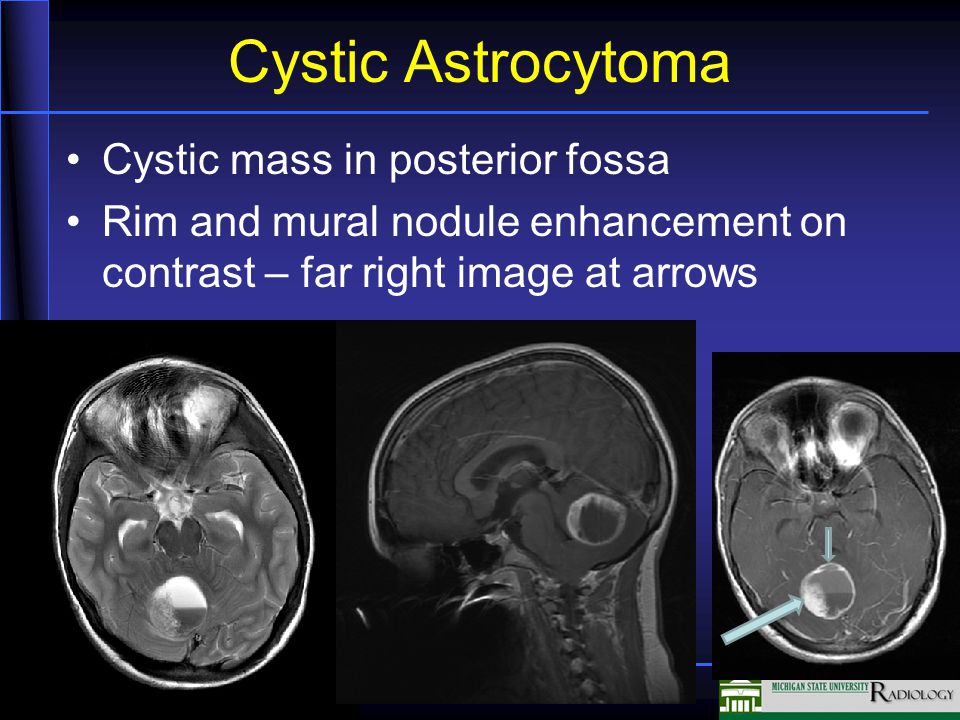 Cystic Astrocytoma Cystic mass in posterior fossa Rim and mural nodule enhancement on contrast – far right image at arrows