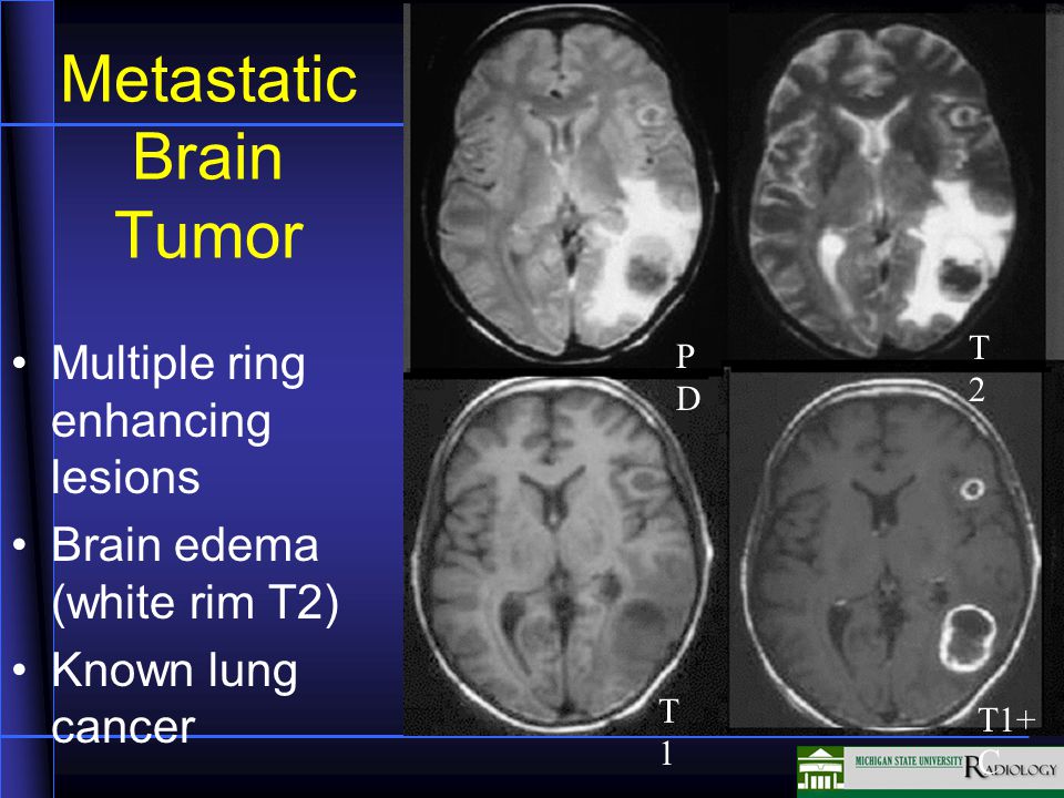 Metastatic Brain Tumor Multiple ring enhancing lesions Brain edema (white rim T2) Known lung cancer T2T2 PDPD T1T1 T1+ C