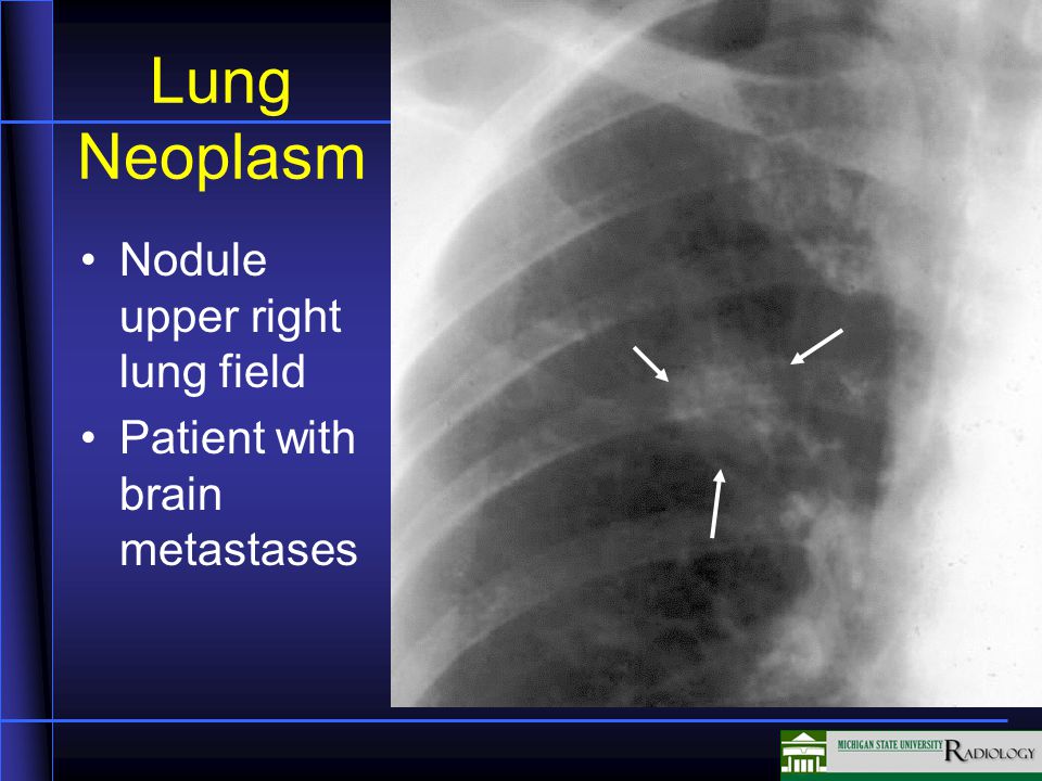 Lung Neoplasm Nodule upper right lung field Patient with brain metastases