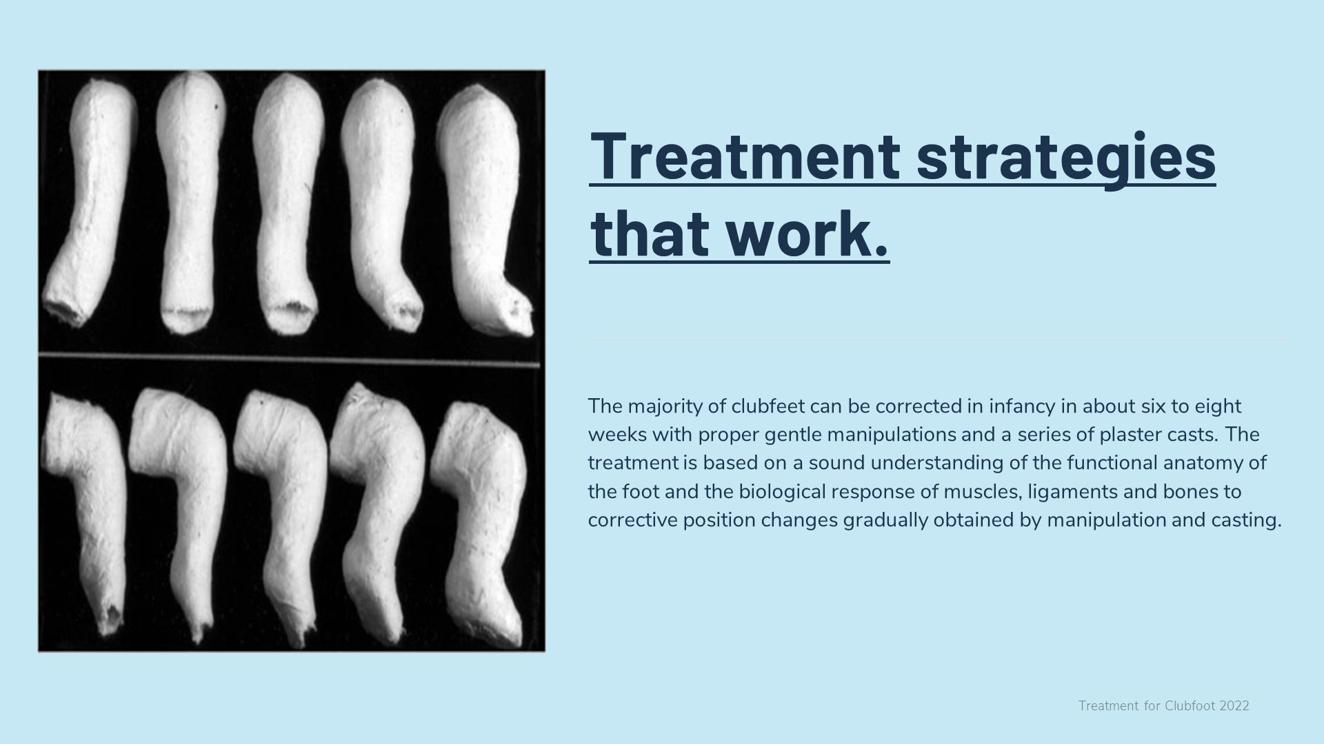 treatment-for-clubfoot-2022-treatment-for-clubfoot-md-orthopaedics