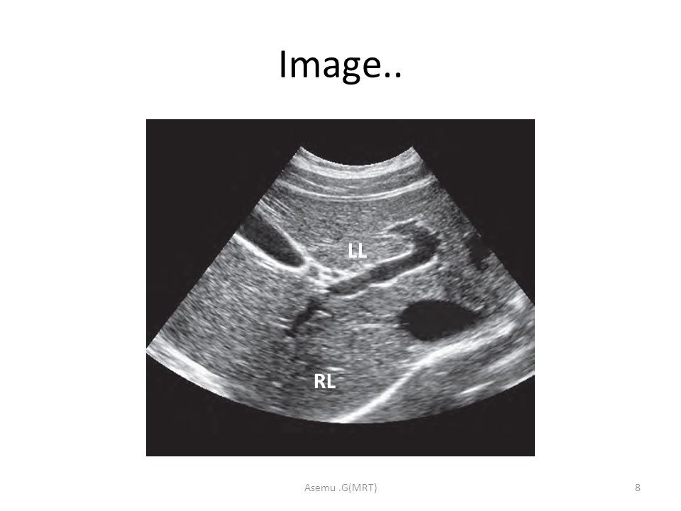 WES sign stands for Wall Echo Shadow sign. It is a triad of: 1- Thick  echogenic gall bladder wall (W) 2- Echoes filling…
