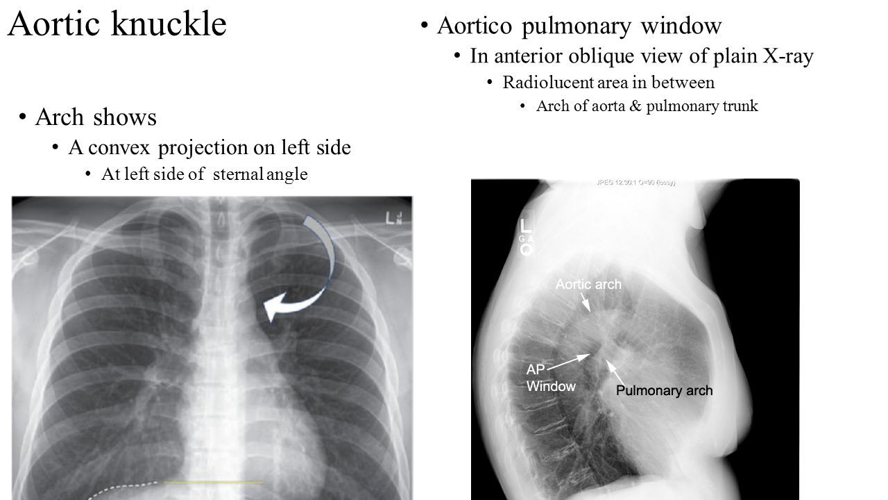 Aorta – ascending, arch and thoracic. Aorta Arises from Left ventricle ...