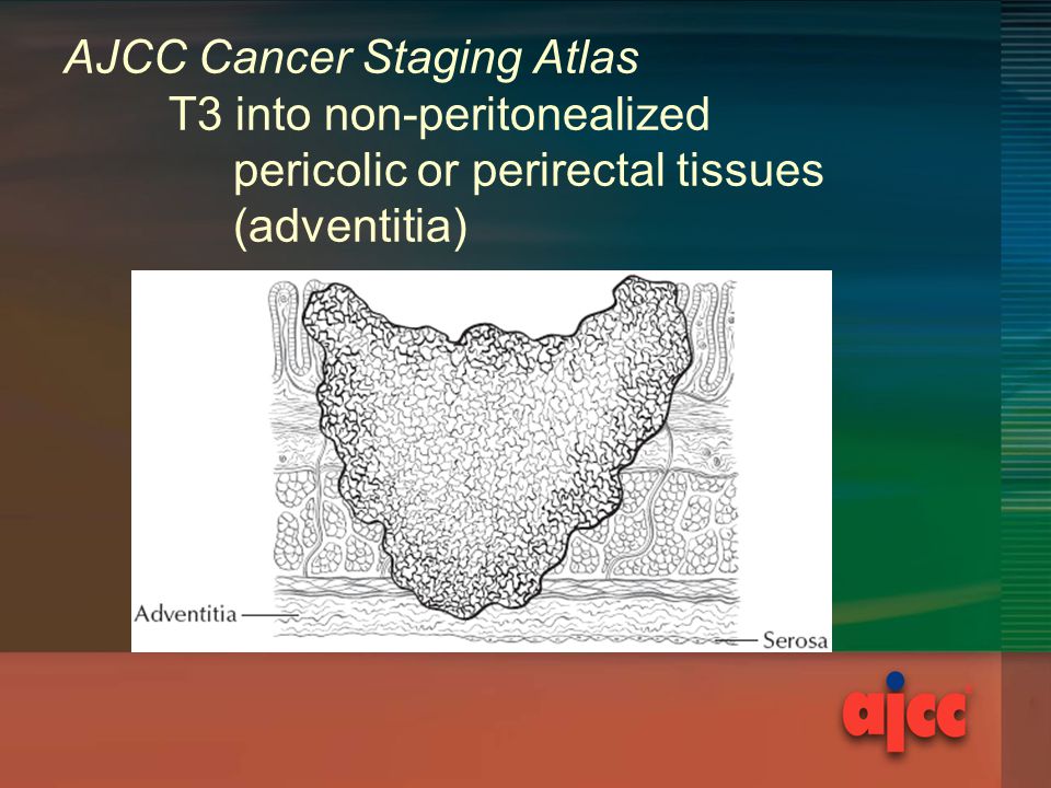 AJCC Cancer Staging Atlas T3 into non-peritonealized pericolic or perirectal tissues (adventitia)