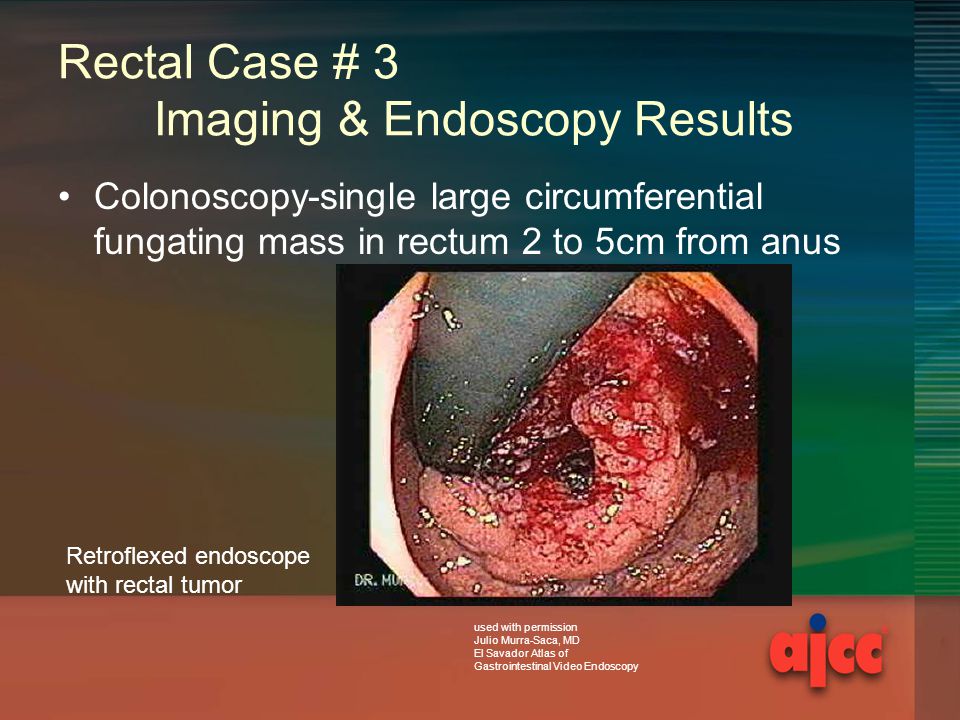 Rectal Case # 3 Imaging & Endoscopy Results Colonoscopy-single large circumferential fungating mass in rectum 2 to 5cm from anus Retroflexed endoscope with rectal tumor used with permission Julio Murra-Saca, MD El Savador Atlas of Gastrointestinal Video Endoscopy