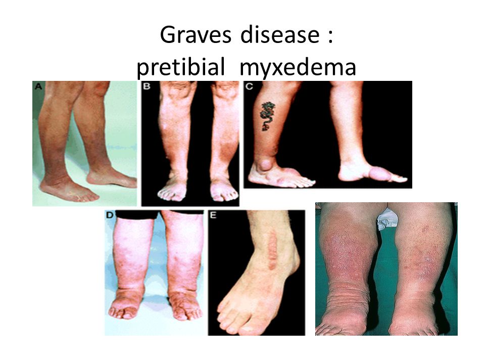Myxedema pretibial Pretibial Myxedema