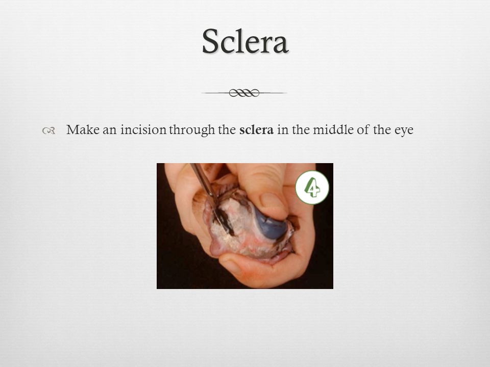 Sclera  Make an incision through the sclera in the middle of the eye