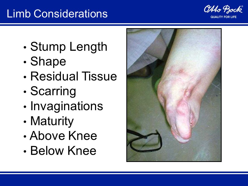 Stump Length Shape Residual Tissue Scarring Invaginations Maturity Above Knee Below Knee Limb Considerations
