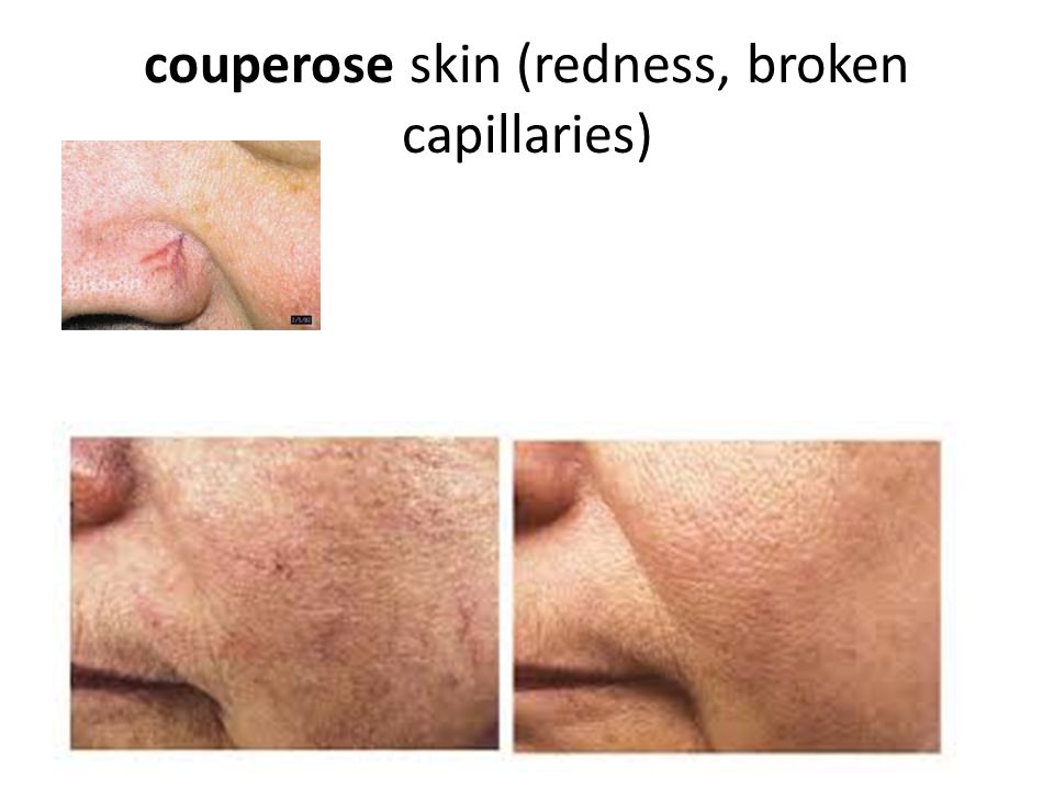 couperose skin (redness, broken capillaries)