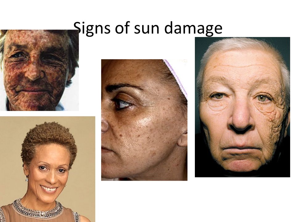 Signs of sun damage