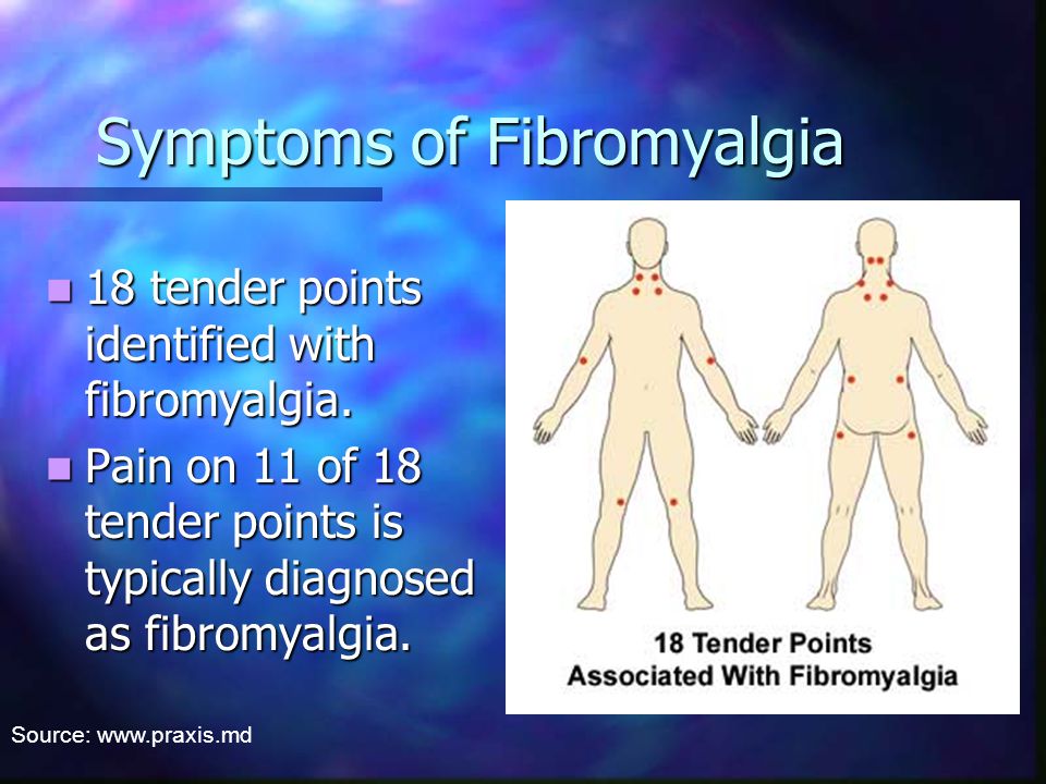 Symptoms of Fibromyalgia 18 tender points identified with fibromyalgia.