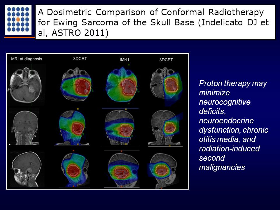A Dosimetric Comparison of Conformal Radiotherapy for Ewing Sarcoma of the Skull Base (Indelicato DJ et al, ASTRO 2011) Proton therapy may minimize neurocognitive deficits, neuroendocrine dysfunction, chronic otitis media, and radiation-induced second malignancies
