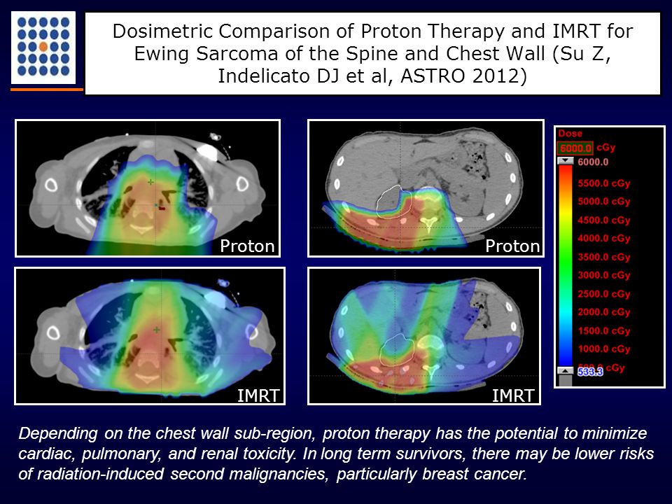 Dosimetric Comparison of Proton Therapy and IMRT for Ewing Sarcoma of the Spine and Chest Wall (Su Z, Indelicato DJ et al, ASTRO 2012) Depending on the chest wall sub-region, proton therapy has the potential to minimize cardiac, pulmonary, and renal toxicity.