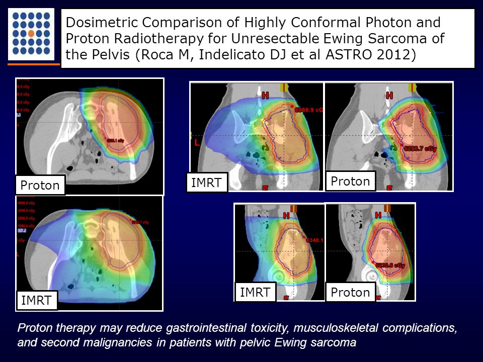 Dosimetric Comparison of Highly Conformal Photon and Proton Radiotherapy for Unresectable Ewing Sarcoma of the Pelvis (Roca M, Indelicato DJ et al ASTRO 2012) Proton therapy may reduce gastrointestinal toxicity, musculoskeletal complications, and second malignancies in patients with pelvic Ewing sarcoma IMRT Proton IMRT Proton IMRTProton
