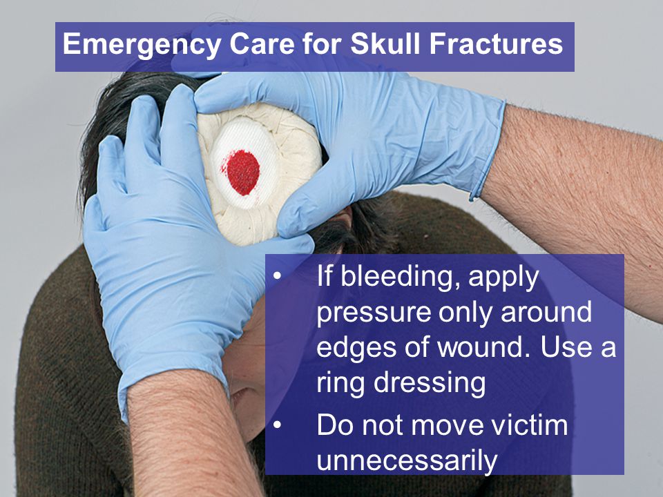 Emergency Care for Skull Fractures If bleeding, apply pressure only around edges of wound.