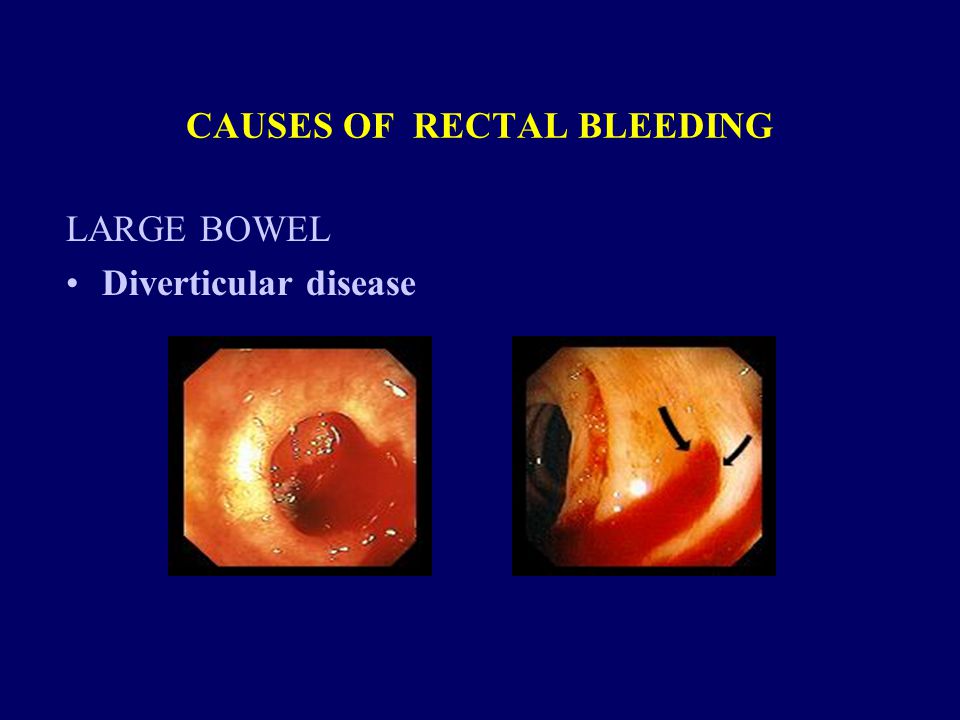 CAUSES OF RECTAL BLEEDING LARGE BOWEL Diverticular disease