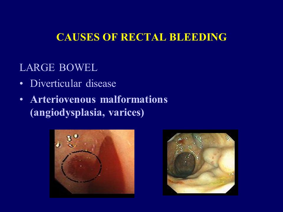 CAUSES OF RECTAL BLEEDING LARGE BOWEL Diverticular disease Arteriovenous malformations (angiodysplasia, varices)