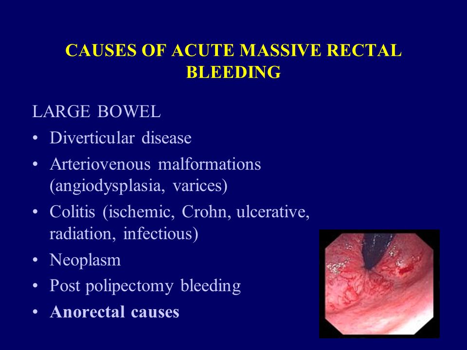 CAUSES OF ACUTE MASSIVE RECTAL BLEEDING LARGE BOWEL Diverticular disease Arteriovenous malformations (angiodysplasia, varices) Colitis (ischemic, Crohn, ulcerative, radiation, infectious) Neoplasm Post polipectomy bleeding Anorectal causes