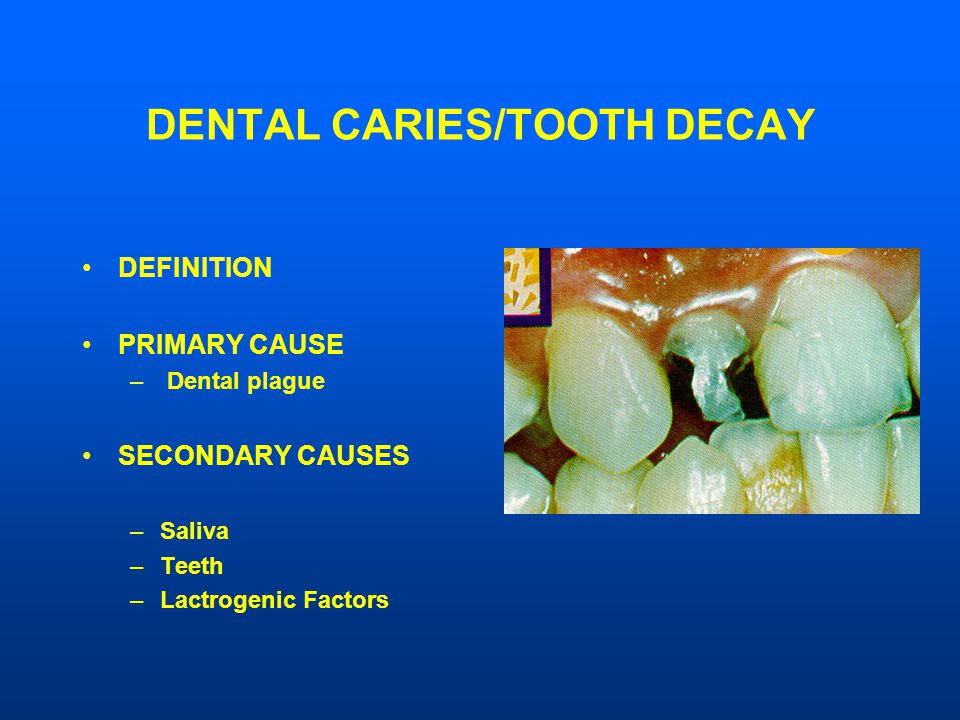 DENTAL CARIES/TOOTH DECAY DEFINITION PRIMARY CAUSE – Dental plague SECONDARY CAUSES –Saliva –Teeth –Lactrogenic Factors